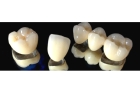 Восстановление зуба с использованием цельнолитой культевой вкладки