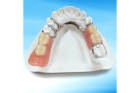 Приварка зуба к протезу