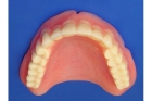 Зубной верхний протез