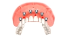 Протезирование зубов на 6 имплантах