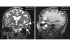 МР-исследование головного мозга на нейродегенерацию, исключение болезни Альцгеймера