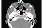 МРТ внутреннего слухового прохода