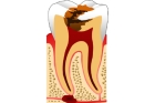 Лечение пульпита постоянного зуба (3 канала) + полная реставрация (2 посещение)