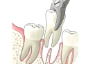 Лечение периодонтита постоянного зуба (1 канал)+ частичная реставрация (2 посещение)