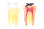 Лечение периодонтита постоянного зуба (4 канала)+ частичная реставрация (1 посещение)
