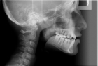 Рентгенография верхней челюсти в косой проекции