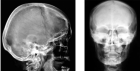 Рентгенография височной кости