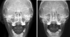 Рентгенография черепа в прямой проекции