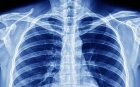 Рентгенография грудины