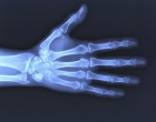 Рентгенография  пальцев, кисти и фаланг руки