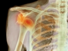 Рентгенография плечевой кости
