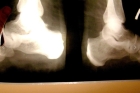 Рентгенография пяточной кости