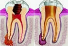 Лечение периодонтита 3 корневого зуба