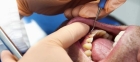 Лечение пульпита зуба
