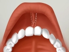 Пластика уздечки губ
