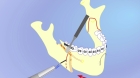 Остеотомия челюсти