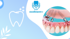 Имплантация зубов All-in-4