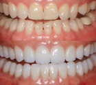 Художественная реставрация зубов пломбировочным материалом