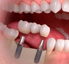 Полное съемное протезирование зубов