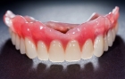 Съемный верхний зубной протез 