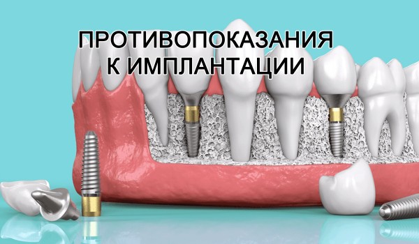 Когда нельзя ставить импланты зубов (противопоказания)
