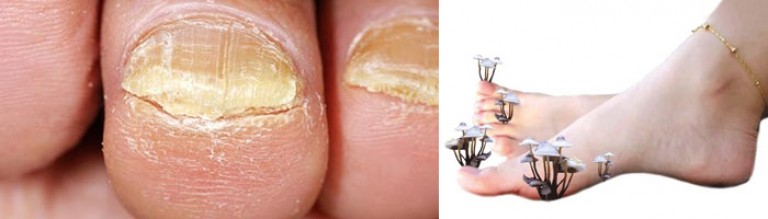 Лечение грибка ногтей от мастера ногтевого сервиса-подолог Валентина