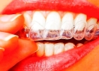 Лечение на одном зубном ряду до 5 капп