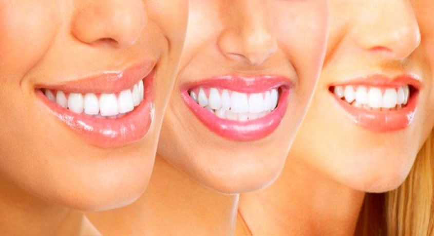 Вы будете улыбаться чаще! Скидка 76% на комплекс «Голливудская улыбка» - ультразвуковая чистка зубов AirFlow + фотоотбеливание.
