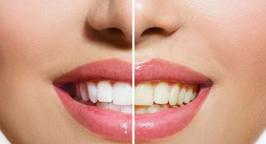 Не стесняйтесь улыбаться! Комплексная профессиональная чистка зубов Air-flow со скидкой 50% в стоматологической клинике «Акула»