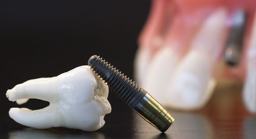 Верните эстетику улыбки! Скидка 51% на постановку 4-х имплантов (1 челюсть) + протезирование от стоматологической клиники Oxford Smile.