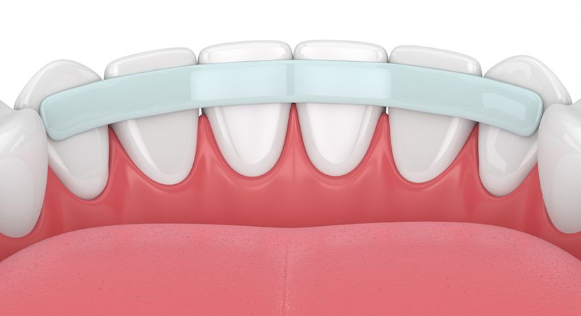 Доверьте заботу о вашей улыбке профессионалам! Шинирование подвижных зубов со скидкой 50% от клиники современной стоматологии «Дента Аrt».