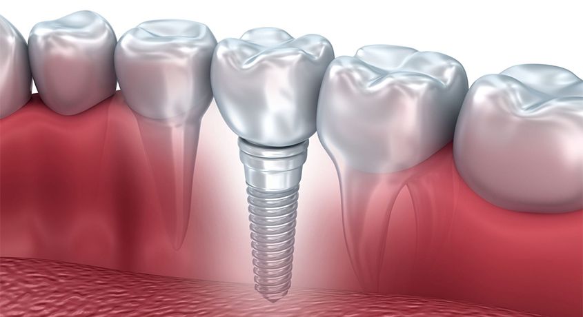 Быстро и качественно! Постановка инновационного имплантата со скидкой 65% в клинике современной стоматологии «Дента Аrt».