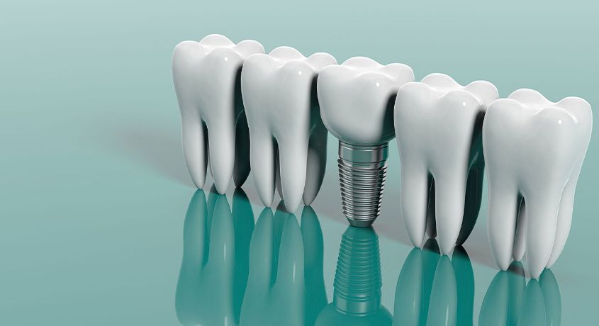 Быстро и качественно! Постановка инновационного имплантата со скидкой 65% в клинике современной стоматологии «Дента Аrt».