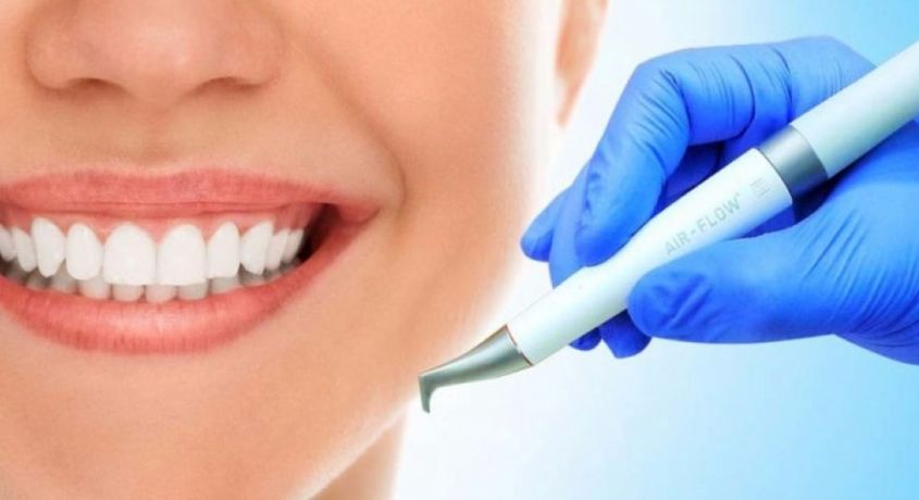 Ослепительная улыбка! Скидка 74% на чистку зубов или отбеливание Air Flow в клинике «Стоматология 33».