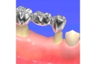 Мостовидные протезы зубов