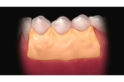 Наложение лечебно-защитной повязки (1 группа зубов)