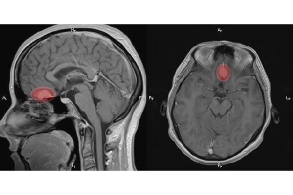 Патологии на мрт. Опухоль головного мозга снимок мрт. Магнито-резонансная томография головного мозга. Туберкулема головного мозга мрт. Телеангиэктазия головного мозга мрт.