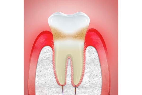 Лечение периодонтита постоянного зуба (2 канала)+ частичная реставрация