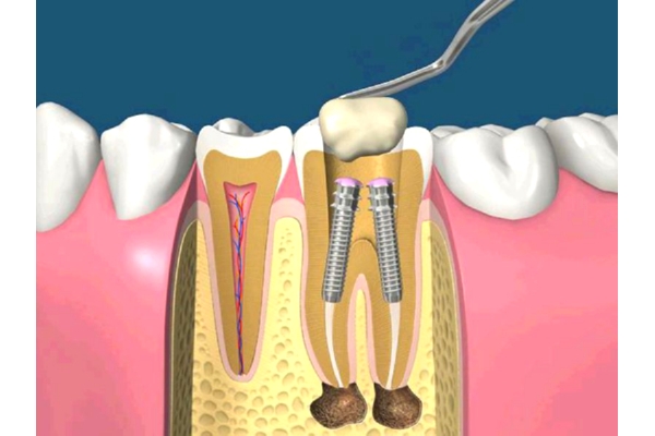 Лечение периодонтита постоянного зуба (4 канала)+ частичная реставрация