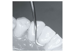 Удаление зубных отложений ручным способом