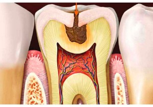 Лечение пульпита постоянного зуба (3 канала) + частичная реставрация