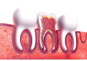 Лечение периодонтита постоянного зуба (1 канал)+ частичная реставрация