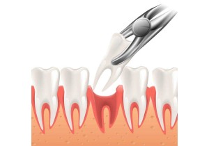Сложное удаление зуба