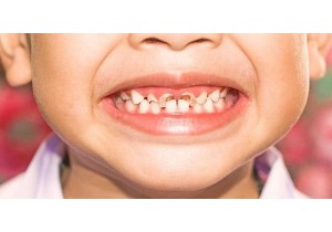 Лечение пульпита у детей постоянный зуб	
