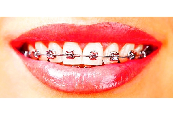 Постановка American ortodontic (металлических брекет-систем)