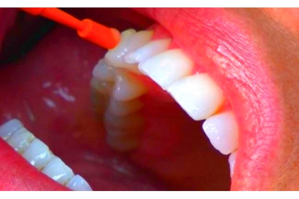 Покрытие зубов кальцийсодержащими и фторсодержащими масками (обе челюсти)