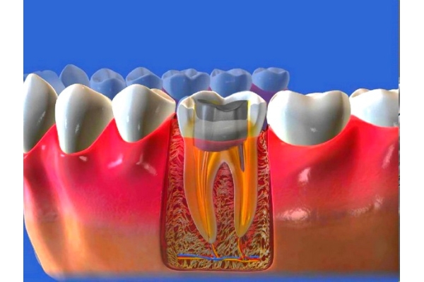 Лечение пульпита и подготовка 3-канального зуба к протезированию