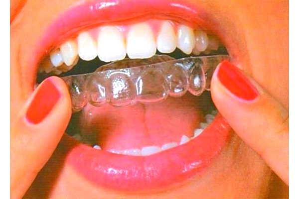 Лечение на двух зубных рядах до 14 капп