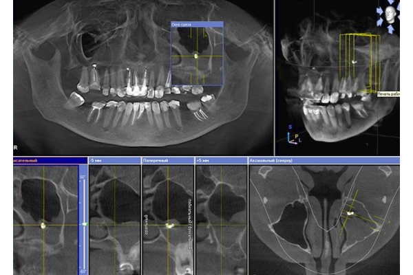 Анализ и расшифровка КТ снимков стоматологом имплантологом