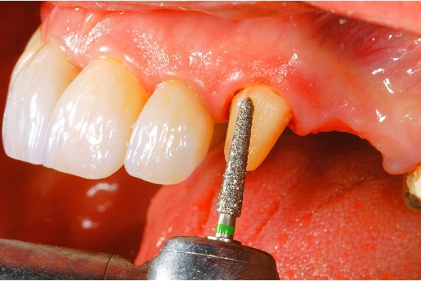 Препарирование одного зуба под штампованную коронку